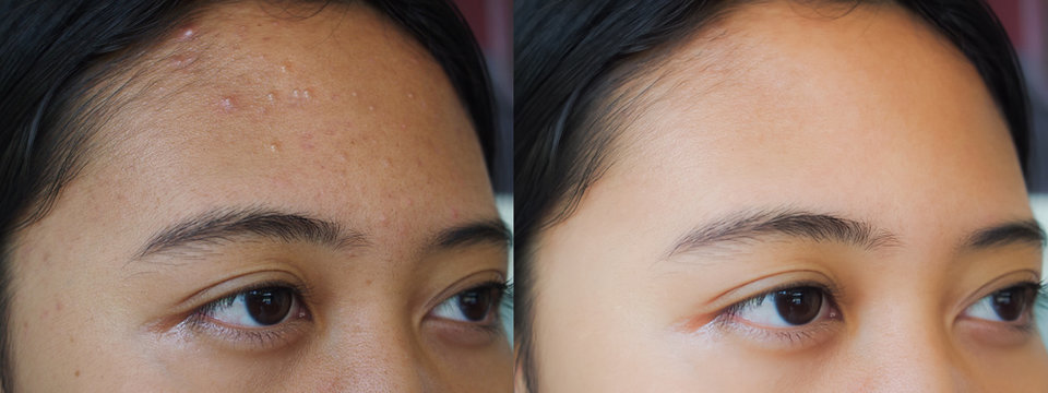 Image before and after acne treatment on the face of young Asian woman. Problem skin and beauty concept.