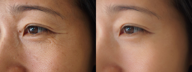 Image before and after treatment rejuvenation surgery on face asian woman concept. Closeup wrinkles...