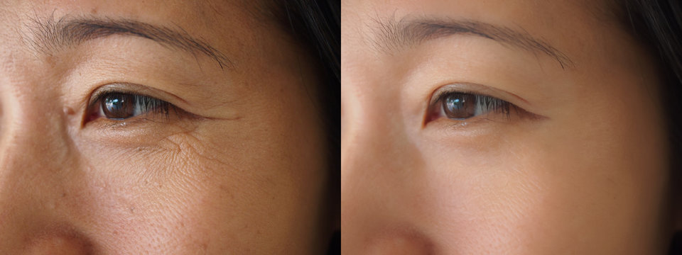 Image before and after treatment rejuvenation surgery on face asian woman concept. Closeup wrinkles dark spots pigmentation on facial female.
