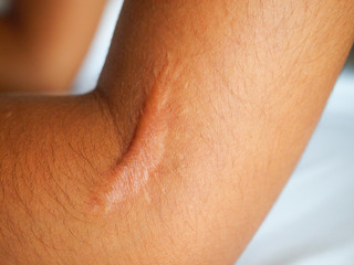 Closeup keloid scar on elbow asian  woman.