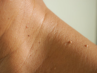 Closeup the skin tags on nesk man skin. - obrazy, fototapety, plakaty