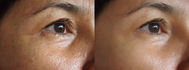 Image before and after treatment rejuvenation surgery on face asian woman concept.Closeup wrinkles...