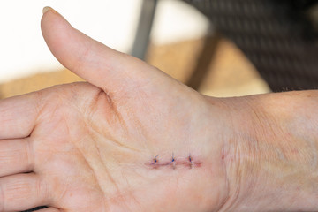 Hand with surgical scar from carpal tunnel syndrome