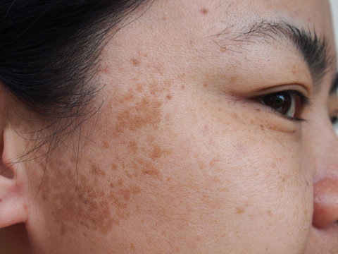 Problem skincare and health concept.Closeup Dark spots melasma freckles,birthmark on face middle age Asian woman.