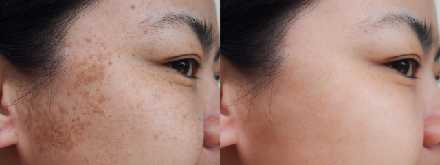 Closeup asian woman face before and after dark spot melasma pigmentation skin facial...