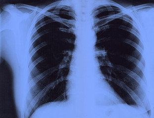 X-ray of the lungs of a healthy person. Female chest x-ray film. Close-up