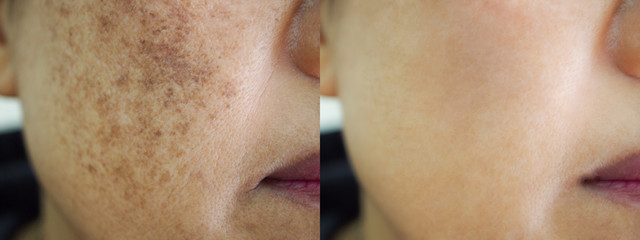 Image before and after spot melasma pigmentation facial treatment on face asian woman.Problem...