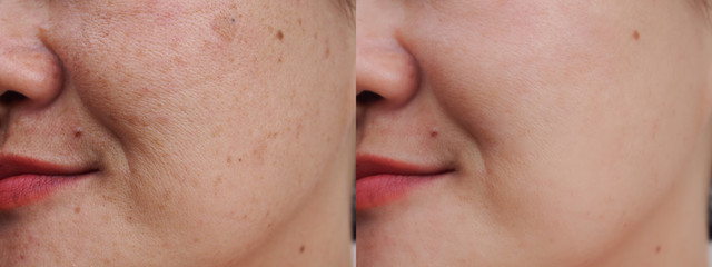 Image before and after spot melasma pigmentation facial treatment on face asian woman.Problem...