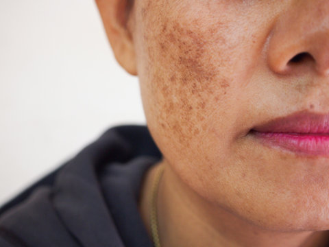 Problem skincare and health concept.Wrinkles,melasma,Dark spots,freckles,dry skin on face middle age asian woman.
