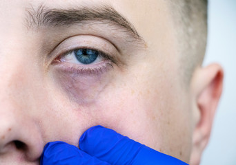 Bags under the eyes, hernias on the face of a man. Plastic surgeon examines a patient before...