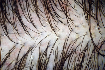 Scalp and hair with multiple exfoliation. Macroscopy of hair on the head with signs of peeling at hair follicles. Scalp dermoscopy. Hair treatment in the clinic.