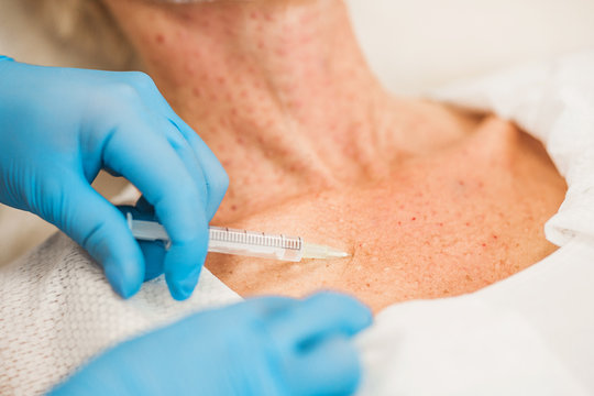 Biorevitalization of the collar and decollete is a procedure that aims to improve the quality of the patient’s skin.