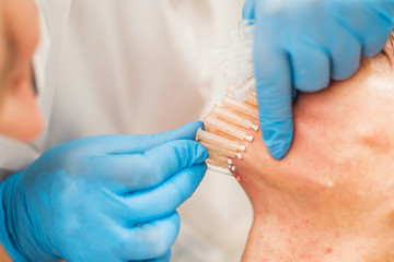 Fototapeta premium Doctor inserts needles into facial skin for thread lifting - aesthetic medicine