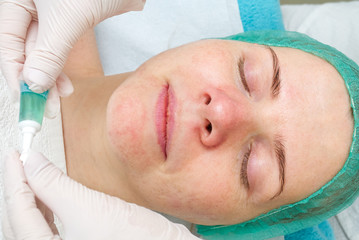 Beautician applies acid on the face of a girl to burn acne. young woman with problem skin. The...