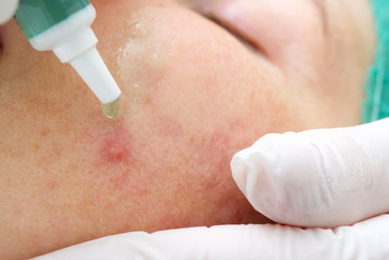 Beautician applies acid on the face of a girl to burn acne. young woman with problem skin. The concept of cosmetology. The cosmetologist performs a procedure to cleanse the face with problem skin.