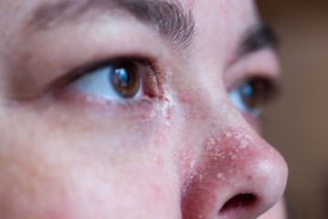 Fototapeta premium Psoriasis an der Nase und am Auge