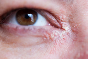 Psoriasis am Auge 