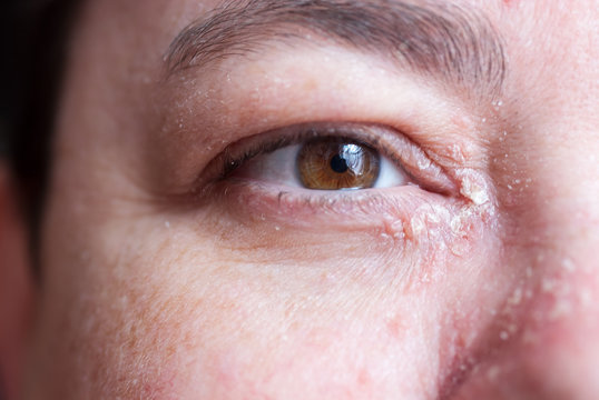 Schuppenflechte - Psoriasis