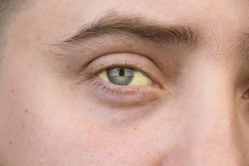 Fototapeta na wymiar The yellow color of the male eye. Symptom of jaundice, hepatitis or problems with the gall bladder, gastrointestinal tract, liver.