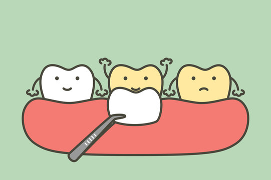 dental veneers installation procedure for tooth whiten - teeth cartoon vector flat style