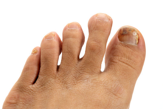 109 BEST 水虫菌 IMAGES, STOCK PHOTOS u0026 VECTORS Adobe Stock