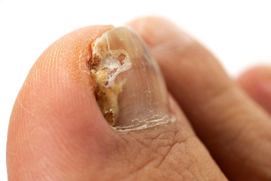 107 Best 水虫菌 Images Stock Photos Vectors Adobe Stock