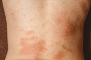 rash on the child's back. red rash in children of preschool age. rubella and chickenpox