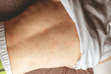 rash on the child's back. red rash in children of preschool age. rubella and chickenpox