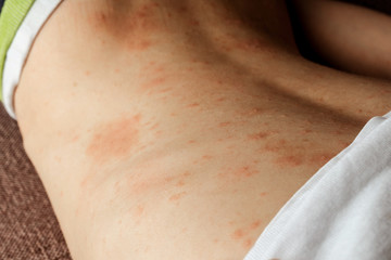 rash on the child's back. red rash in children of preschool age. rubella and chickenpox