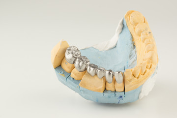 Artificial tooth crown