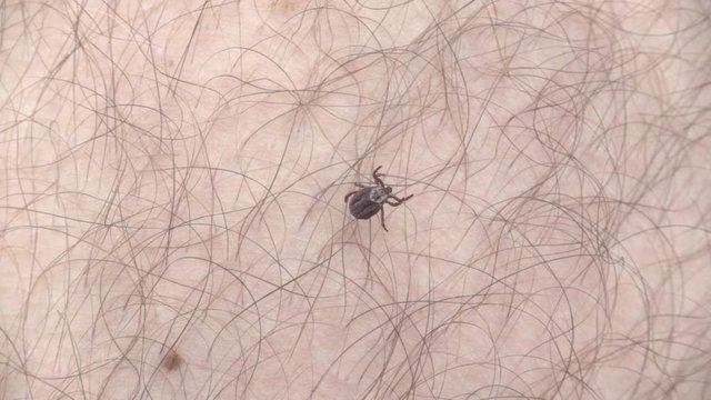 Tick on the human skin slow motion, 240 fps. Tick-borne disease vector