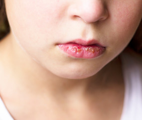 Herpes on the lips of a child