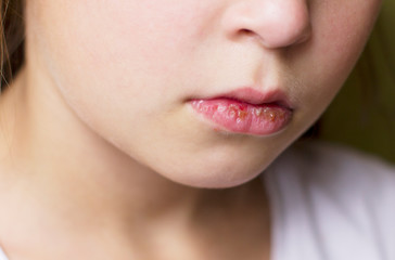 Obraz premium Herpes on the lips of a child