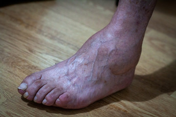 closeup feet of old man suffering from leprosy with a cane on the ground