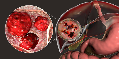 Hydatid cyst of Echinococcus granulosus in the liver - obrazy, fototapety, plakaty