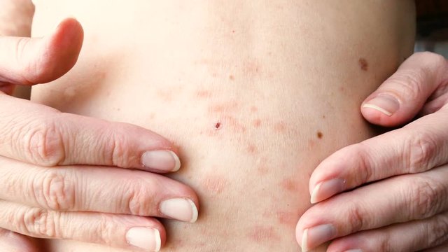 skin rash treatment on woman body. Shingles, Disease, Herpes zoster, varicella-z, lichenoid dermatitis	