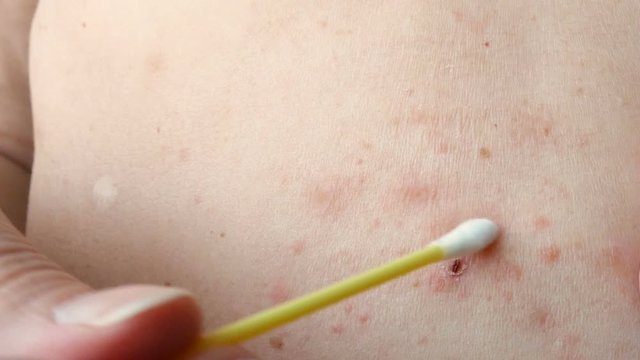 skin rash treatment on woman body. Shingles, Disease, Herpes zoster, varicella-z, lichenoid dermatitis	