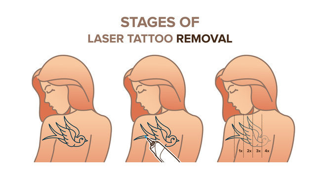 Stages of laser tattoo removal. Vector illustration
