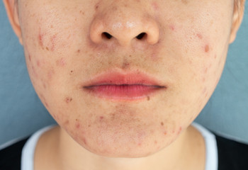 Close-up of woman half face with problems of acne inflammation (Papule and Pustule) on her face....