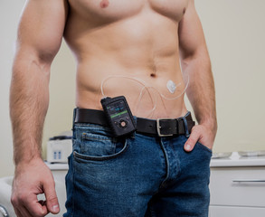 Diabetic man with an insulin pump connected in his abdomen and keeping the insulin pump