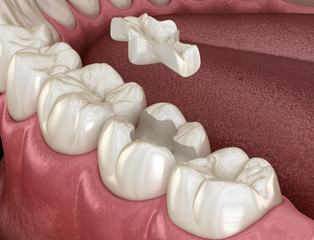 Inlay ceramic crown fixation over tooth. Medically accurate 3D illustration of human teeth treatment