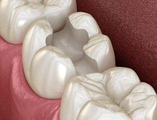 Tooth preparation for inlay placement. Medically accurate 3D illustration of human teeth treatment