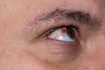 Eye injury, young man with burst blood vessel in eye, fatigue, problems with blood vessels