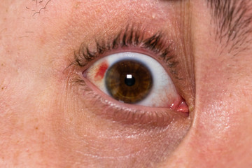 Eye injury, young man with burst blood vessel in eye, fatigue, problems with blood vessels