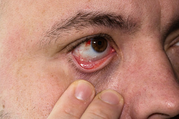 Eye injury, young man with burst blood vessel in eye, fatigue, problems with blood vessels