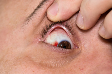 Eye injury, young man with burst blood vessel in eye, fatigue, problems with blood vessels