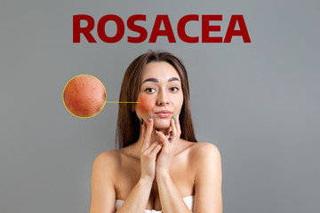 The concept of rosacea. A young Caucasian woman touches her cheeks with rosacea. Copy space. Zoom...
