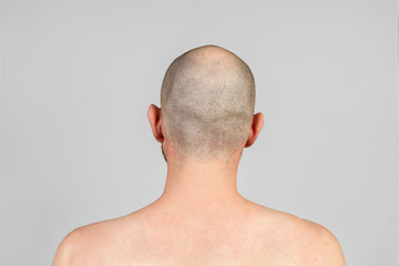 Male alopecia. A man with a bald head. Rear view. Gray background. Copy space