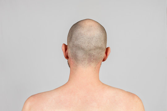 Male alopecia. A man with a bald head. Rear view. Gray background. Copy space