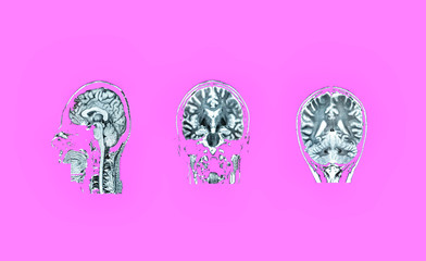 MRI of the head on a pink background. The concept of timely detection of diseases of the head. Mental health.